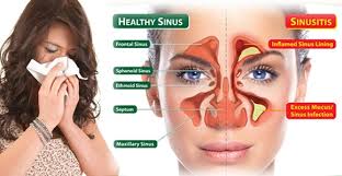 Pahami Bahaya Komplikasi Sinusitis